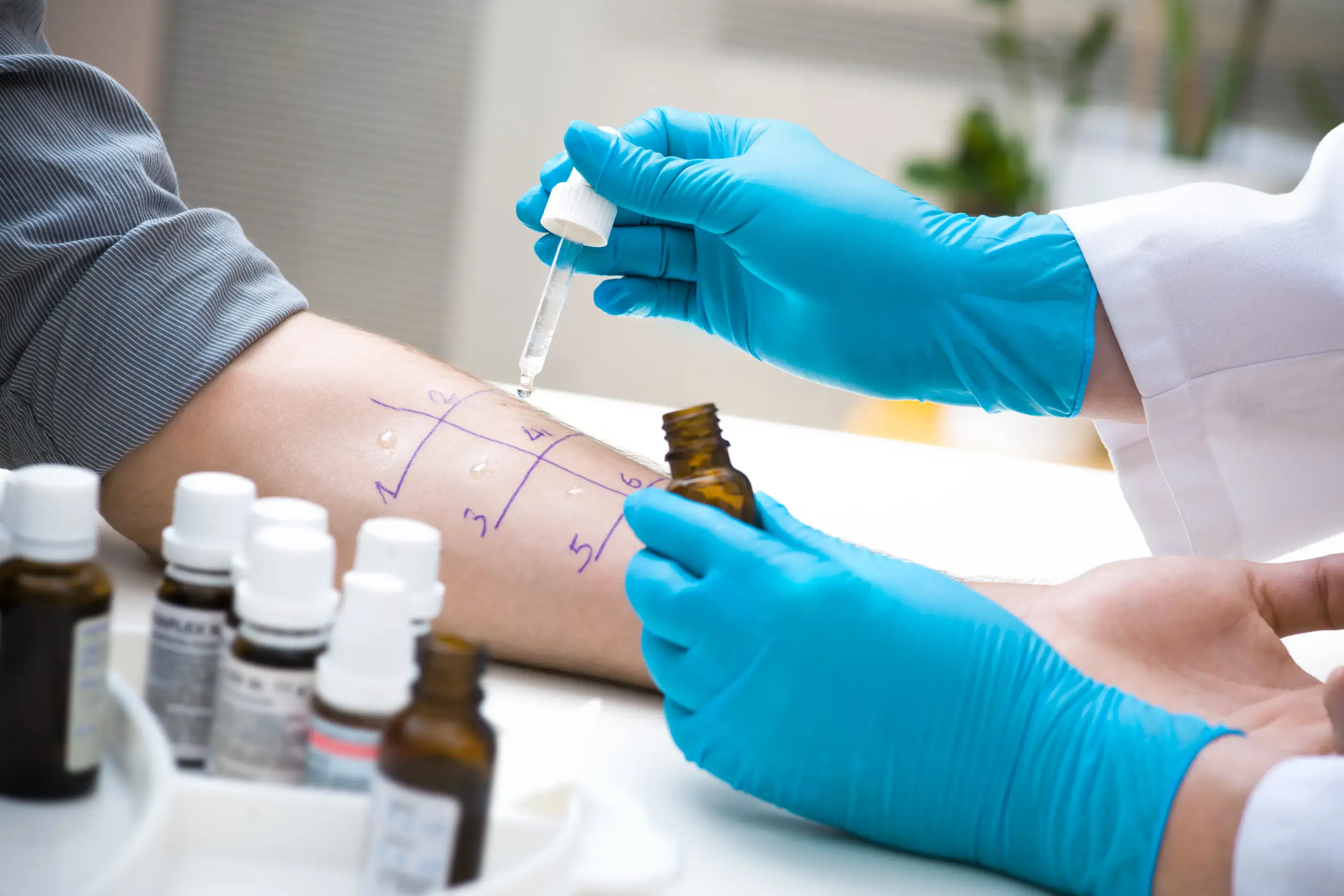 A skin prick allergy test being carried out.